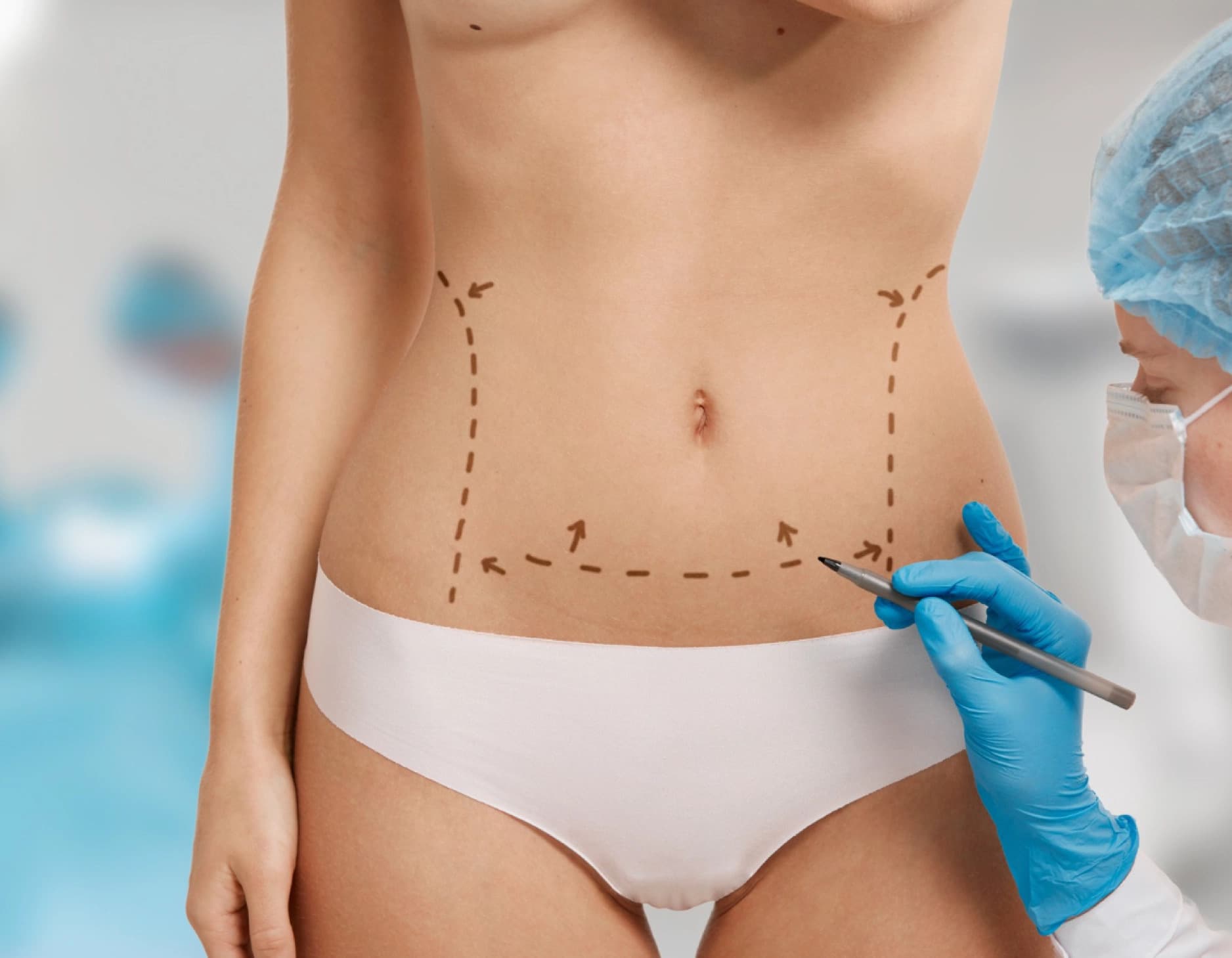 Abdominoplastia