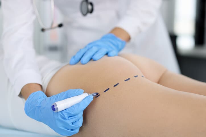 Gluteoplastia con Implantes