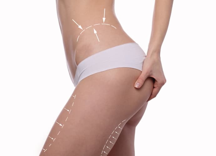 Lipotransferencia (BBL)