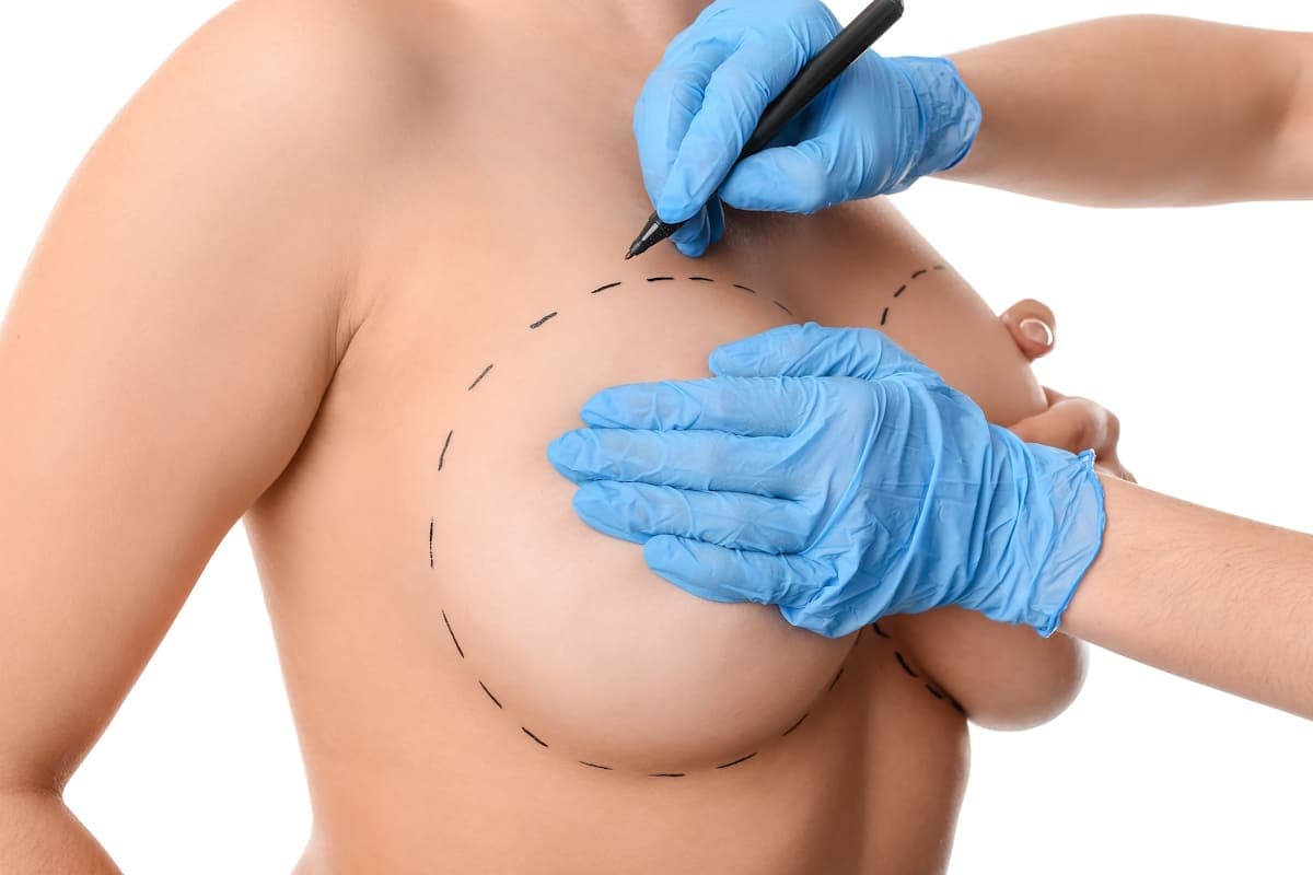 Mamoplastia Reductora