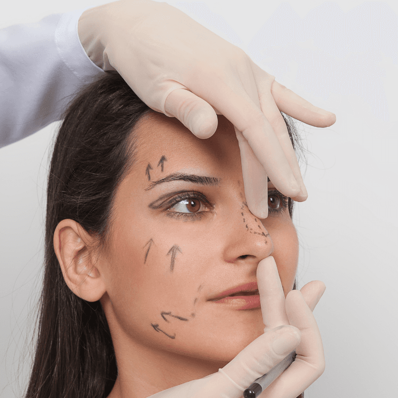 Rinoplastia